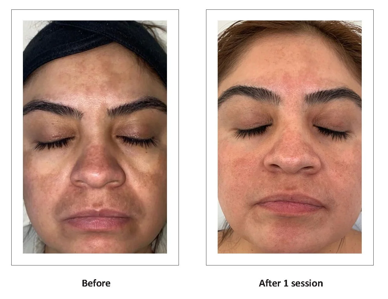 LumiMax CO2 discoloration treatment result