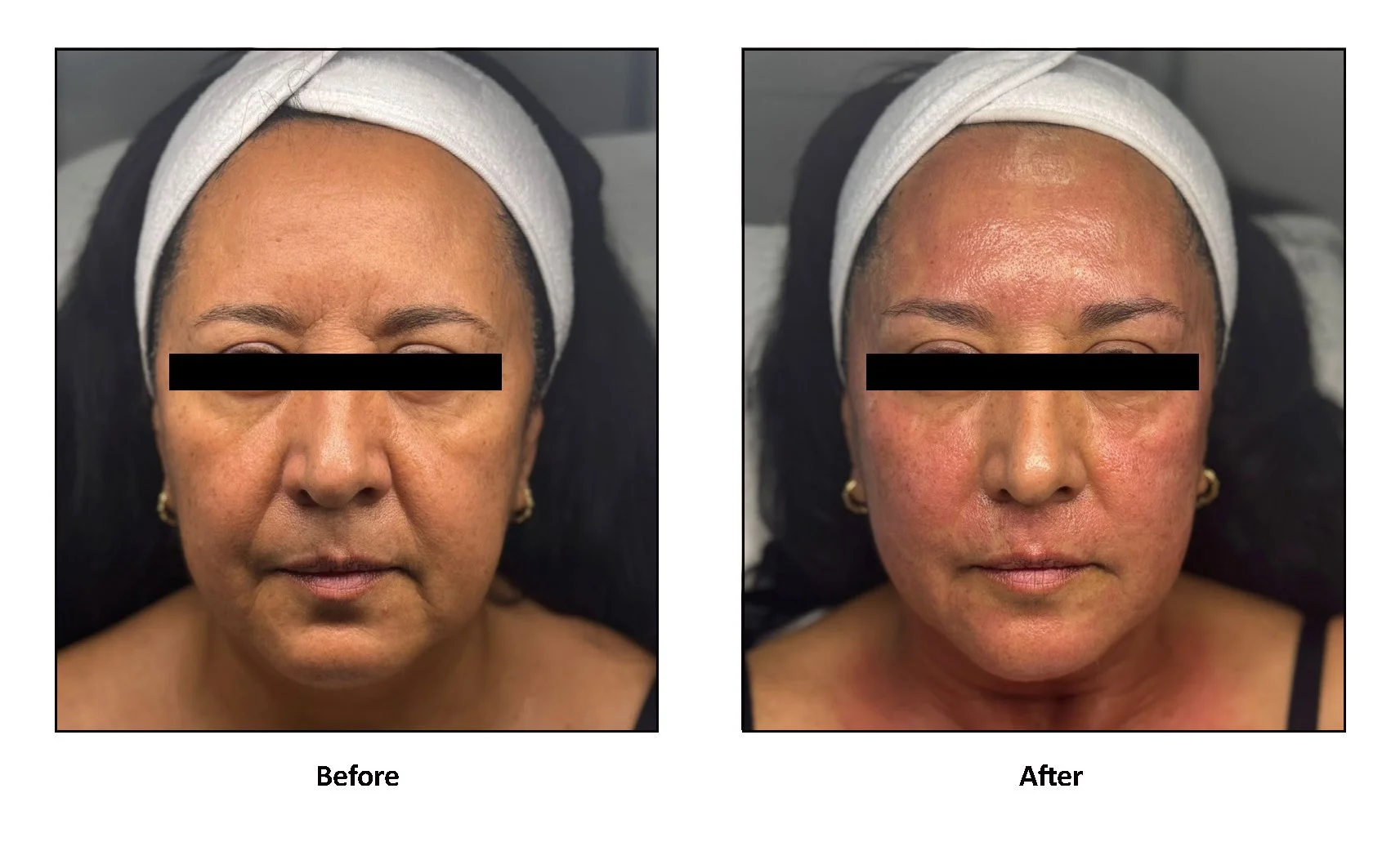 DermaMax RF clinical case — fine lines and wrinkles, single session