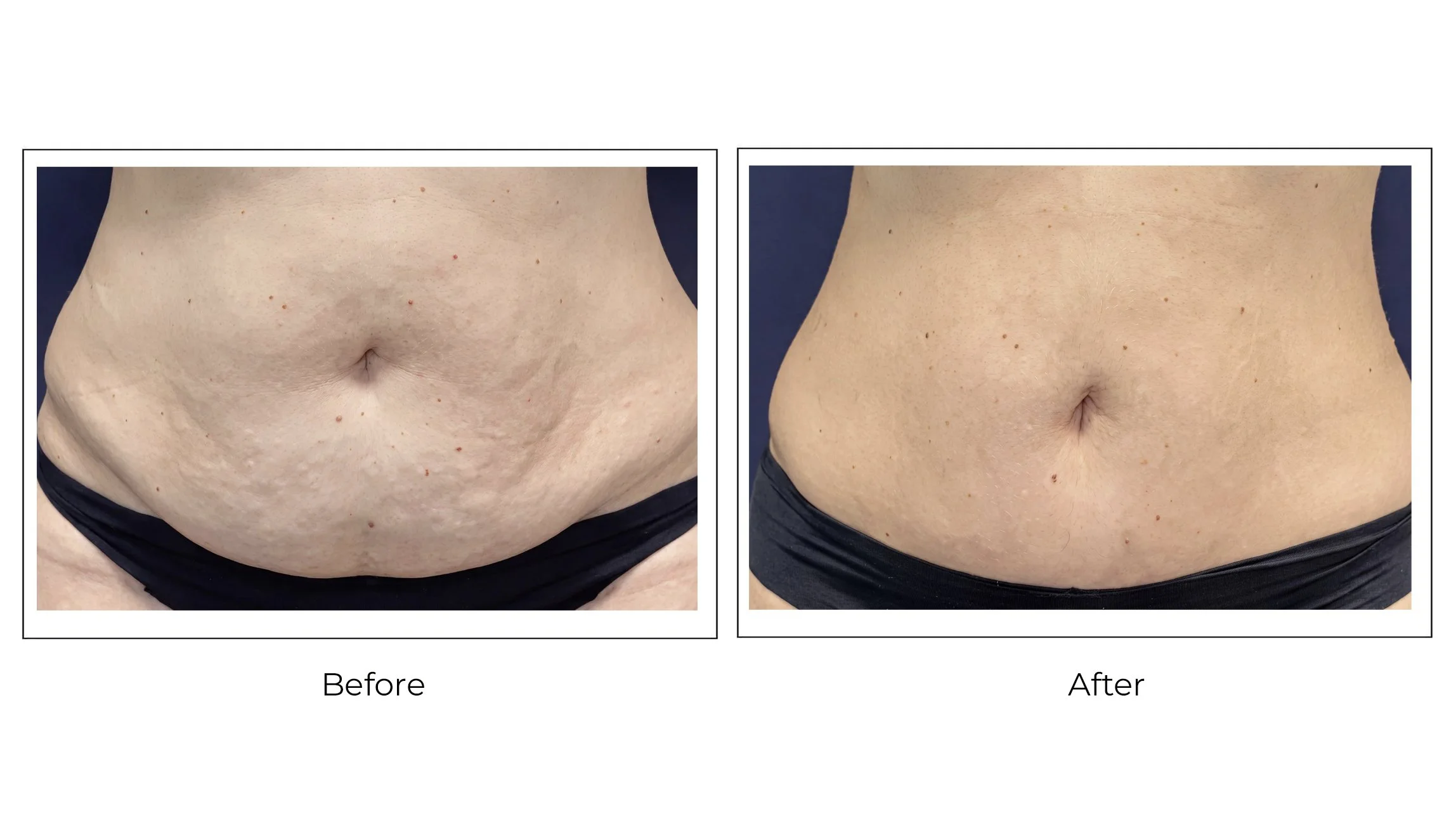 Skin tightening treatment