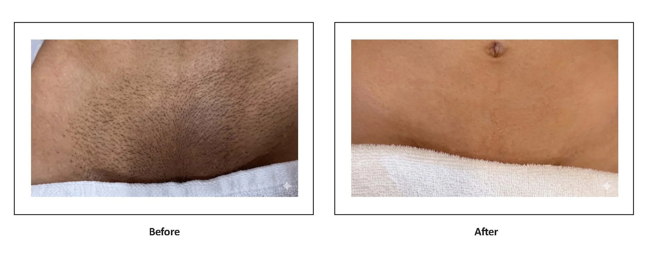 LumiMax PL clinical result, bikini area