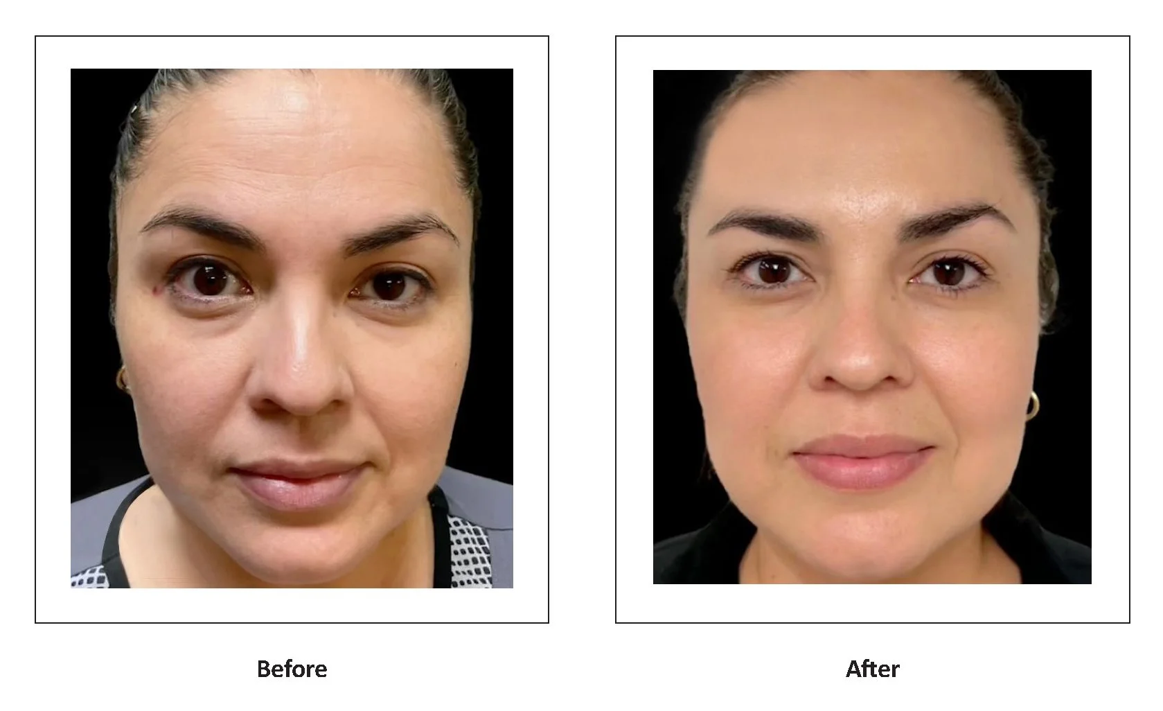 LumiMax CO2 rejuvenation result, view 1