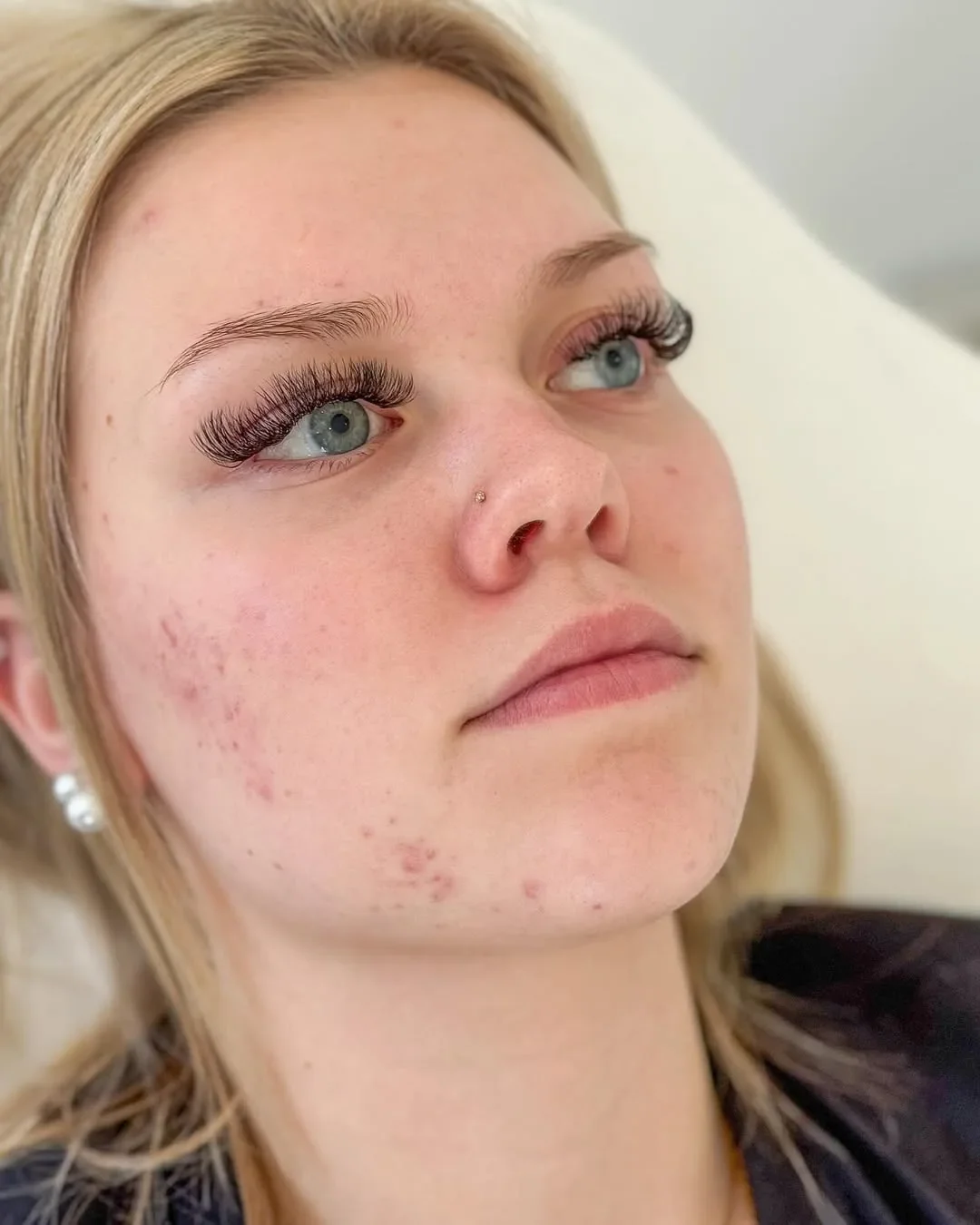 Före fillersbehandling