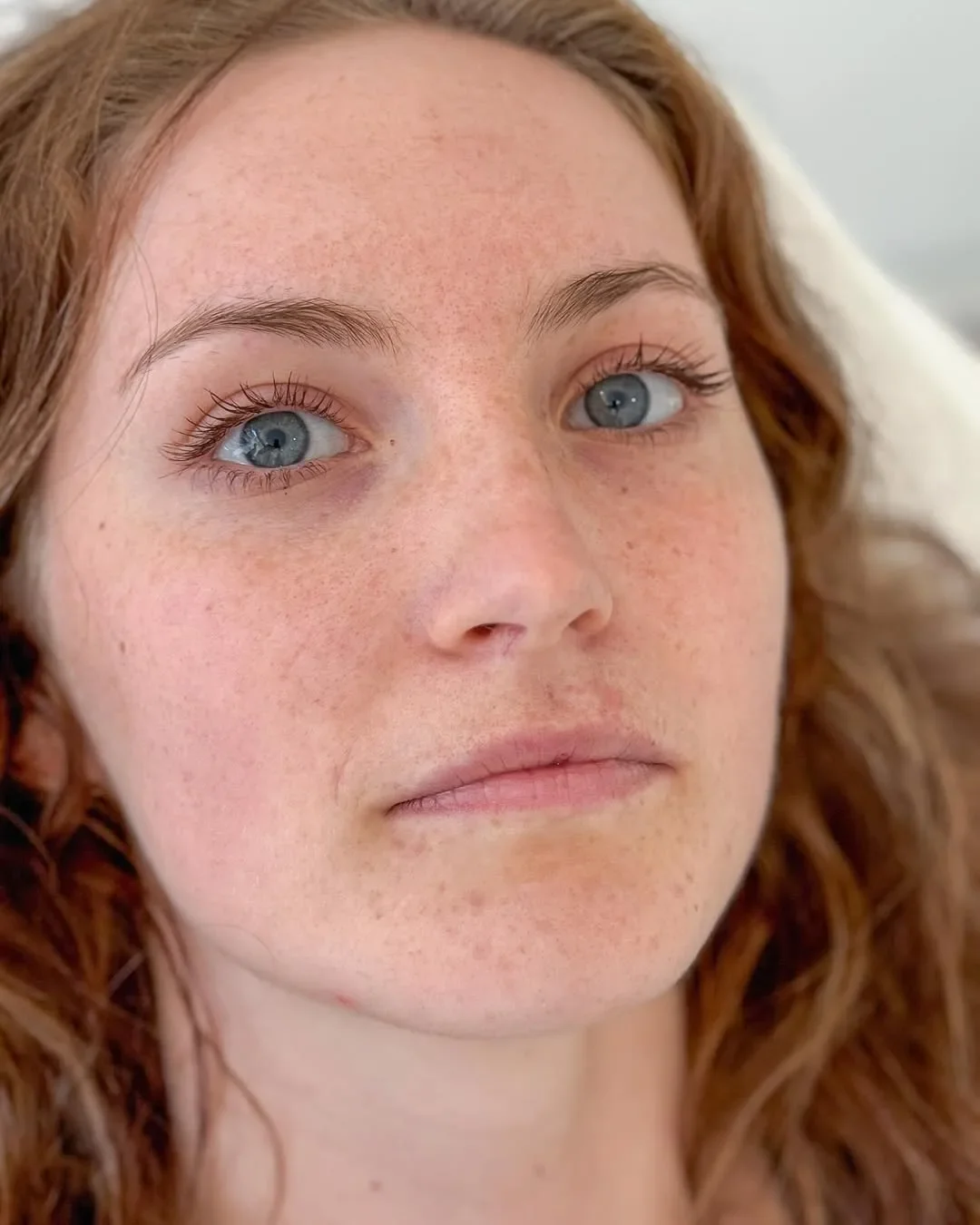 Före fillersbehandling