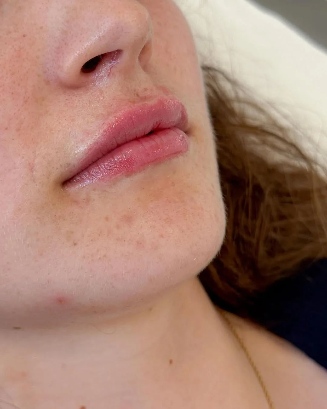 Efter fillersbehandling