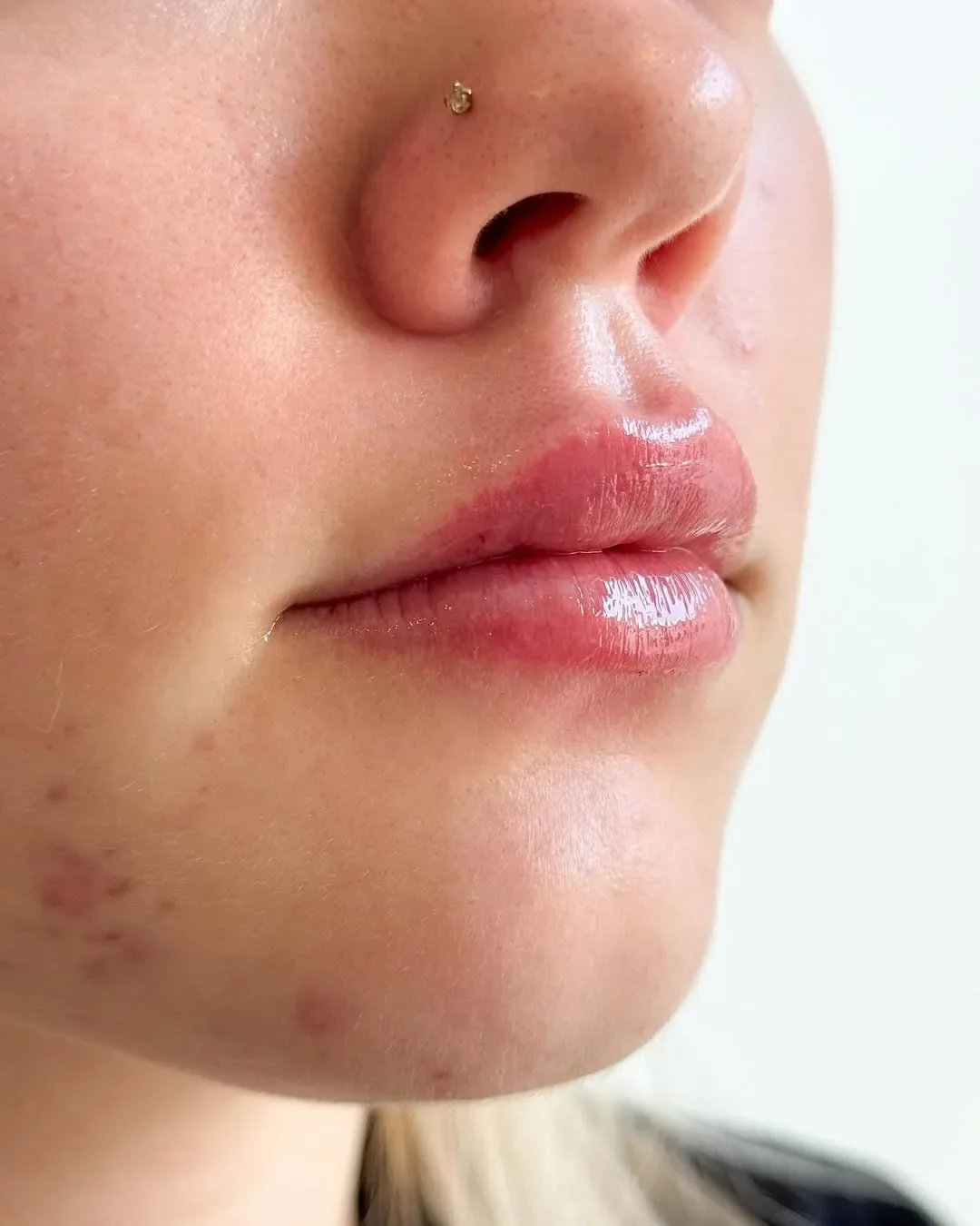 Efter fillersbehandling