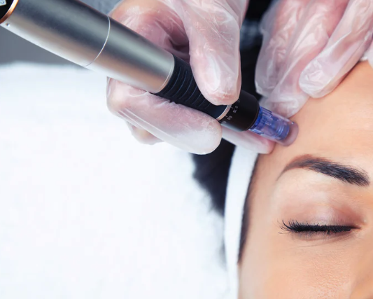 Gloved practitioner using a microneedling pen on a client’s face, a skincare service at Recoupia in Lynnwood