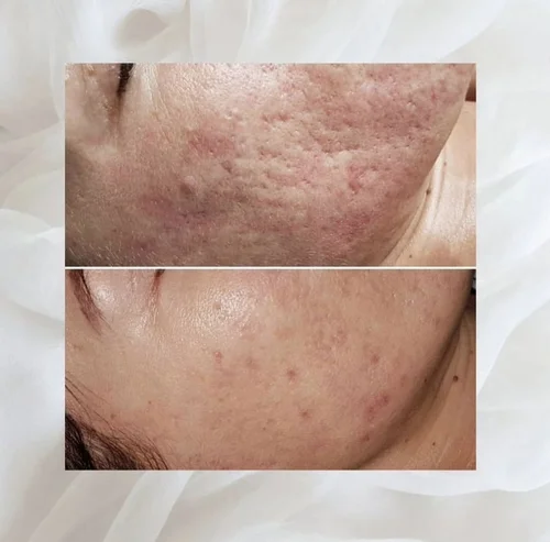 Acne and skin treatment before and after at Dolce Vita Aesthetics, Miami