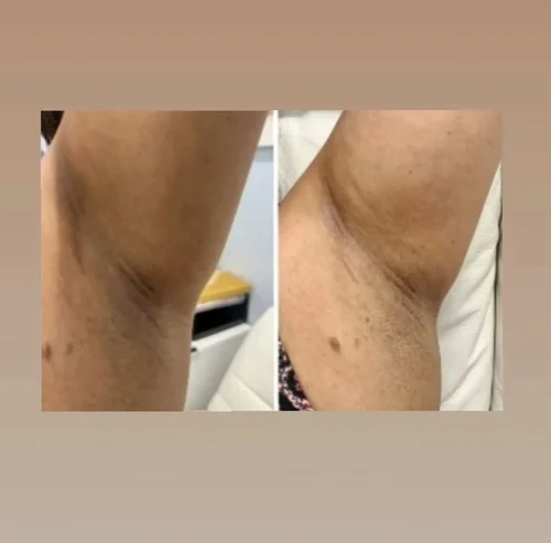 Underarm skin lightening before and after at Dolce Vita Aesthetics, Miami