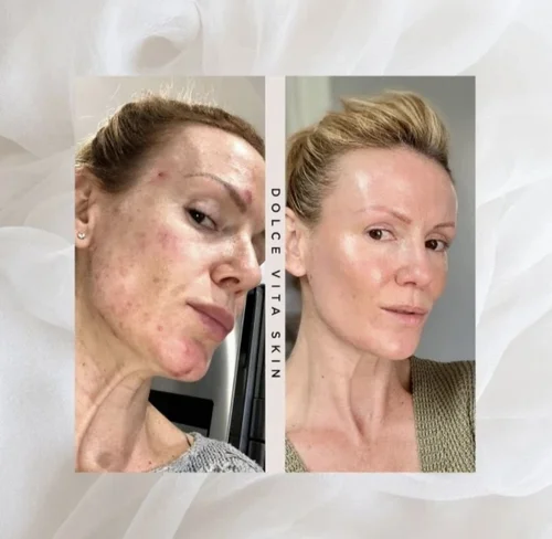 Acne and skin treatment before and after at Dolce Vita Aesthetics, Miami