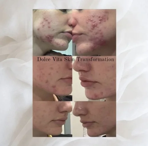 Acne and skin treatment before and after at Dolce Vita Aesthetics, Miami