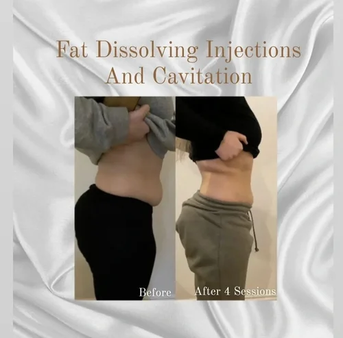 Fat dissolving and ultrasonic cavitation before and after at Dolce Vita Aesthetics, Miami