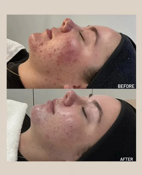 Acne and skin treatment before and after at Dolce Vita Aesthetics, Miami