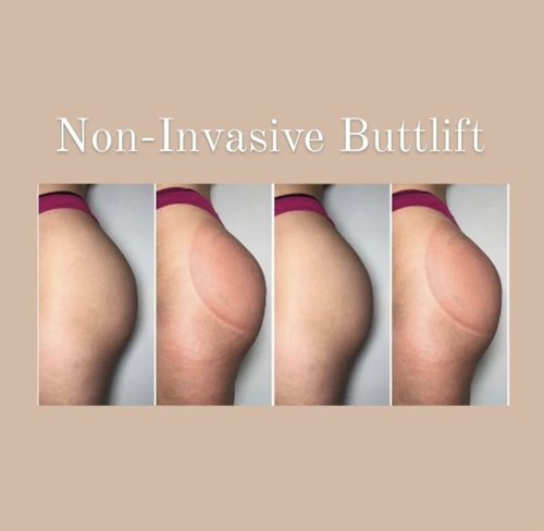 Non-invasive butt lift before and after at Dolce Vita Aesthetics, Miami