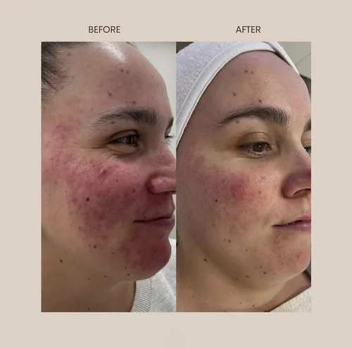 Acne and skin treatment before and after at Dolce Vita Aesthetics, Miami