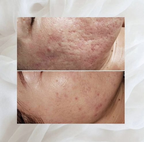 Acne and skin treatment before and after at Dolce Vita Aesthetics, Miami