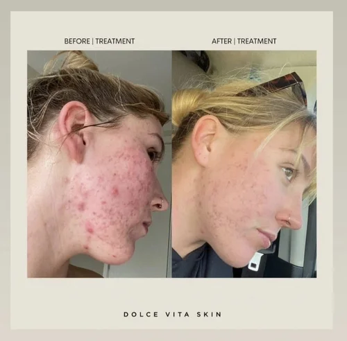 Acne and skin treatment before and after at Dolce Vita Aesthetics, Miami