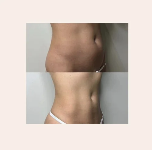 Body sculpting before and after at Dolce Vita Aesthetics, Miami