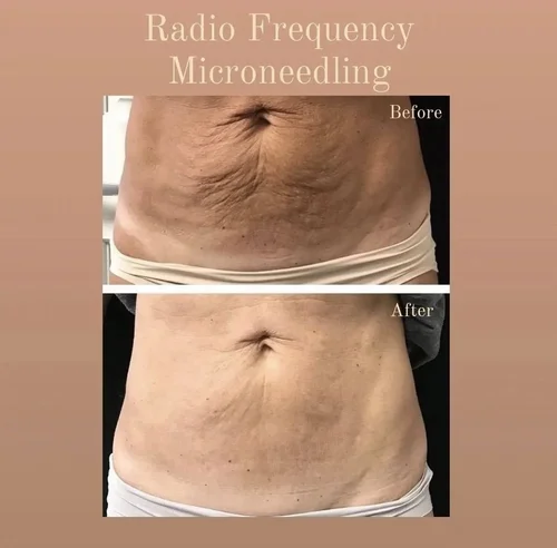 RF microneedling before and after at Dolce Vita Aesthetics, Miami