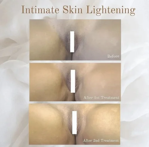 Intimate skin lightening before and after at Dolce Vita Aesthetics, Miami