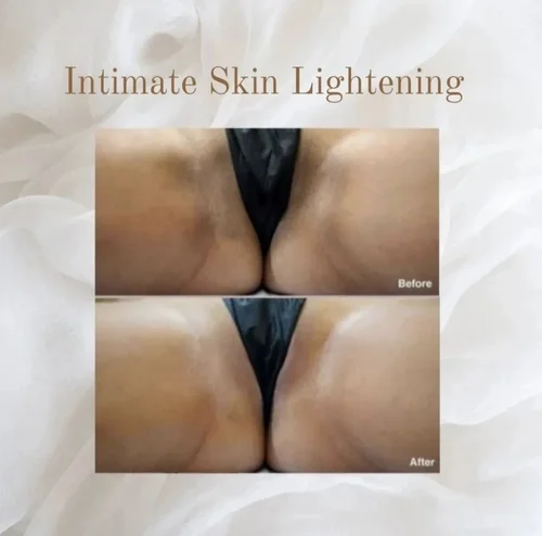 Intimate skin lightening before and after at Dolce Vita Aesthetics, Miami