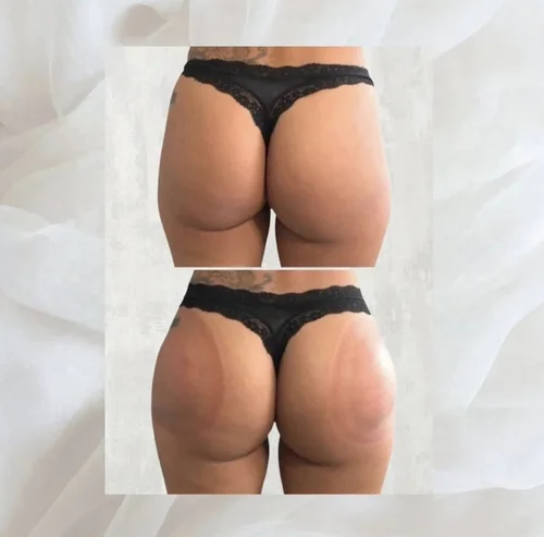 Body sculpting before and after at Dolce Vita Aesthetics, Miami