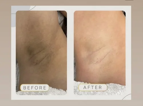 Body sculpting before and after at Dolce Vita Aesthetics, Miami