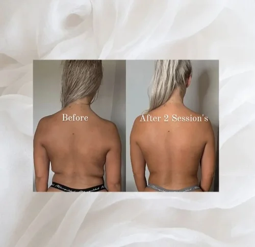 Body sculpting before and after at Dolce Vita Aesthetics, Miami