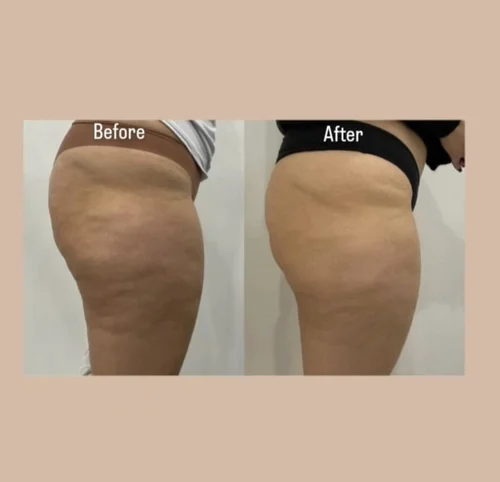Body sculpting before and after at Dolce Vita Aesthetics, Miami