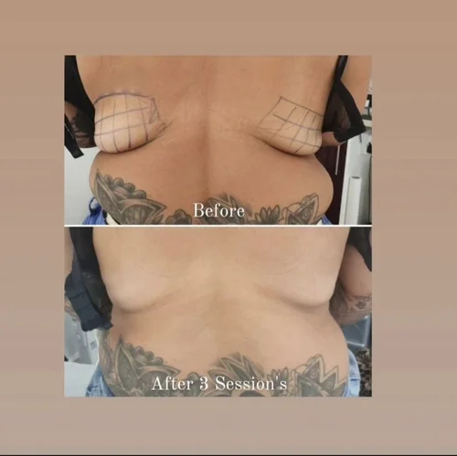 Non-surgical fat reduction before and after at Dolce Vita Aesthetics, Miami