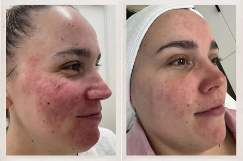 Acne and skin treatment before and after at Dolce Vita Aesthetics, Miami