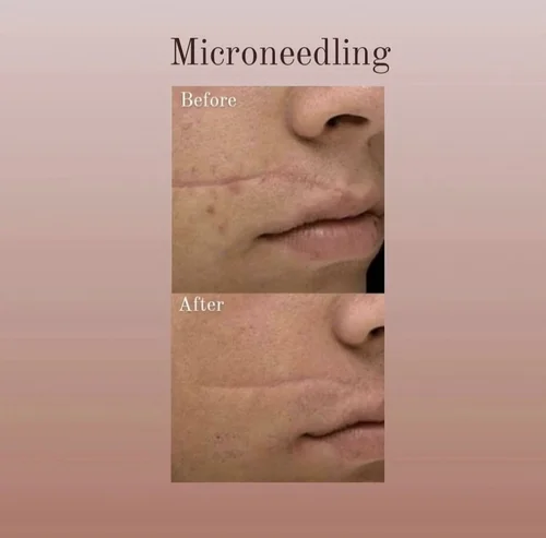 Microneedling before and after at Dolce Vita Aesthetics, Miami