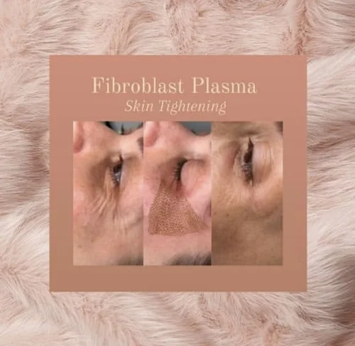 Fibroblast plasma skin tightening before and after at Dolce Vita Aesthetics, Miami