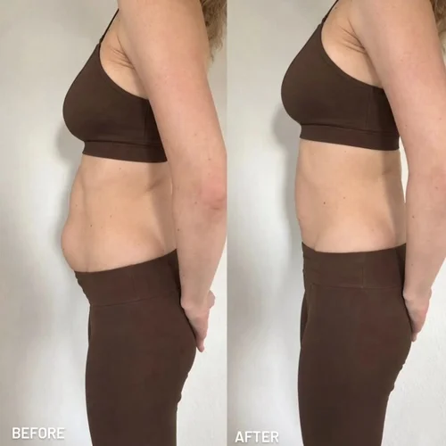 Body sculpting before and after at Dolce Vita Aesthetics, Miami
