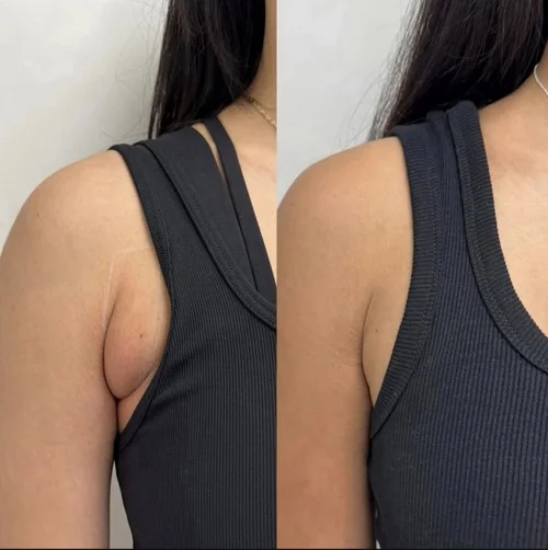 Body sculpting before and after at Dolce Vita Aesthetics, Miami