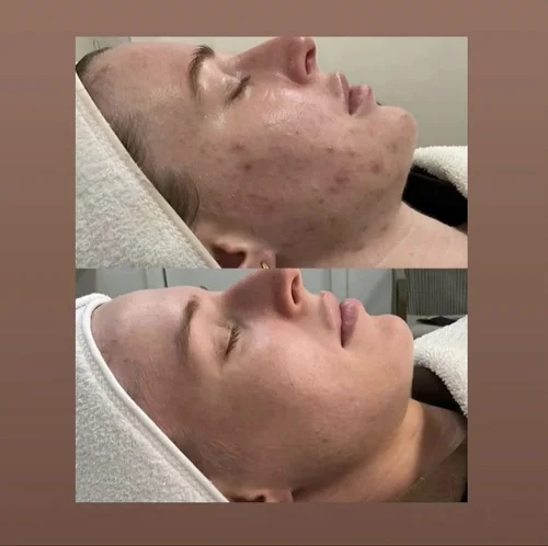 Acne and skin treatment before and after at Dolce Vita Aesthetics, Miami
