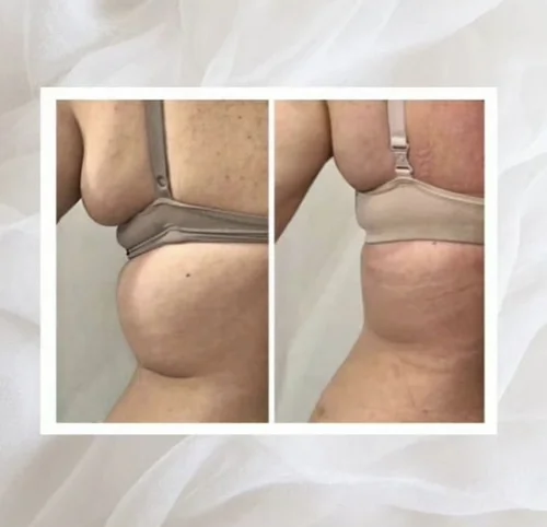 Body sculpting before and after at Dolce Vita Aesthetics, Miami