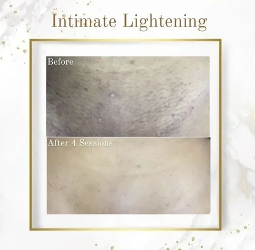 Intimate skin lightening before and after at Dolce Vita Aesthetics, Miami