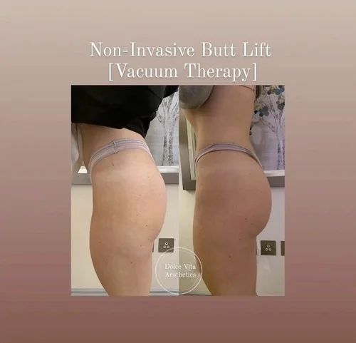 Vacuum butt lift before and after at Dolce Vita Aesthetics, Miami