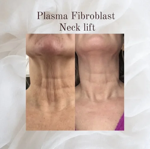 Fibroblast plasma pen neck lift before and after at Dolce Vita Aesthetics, Miami
