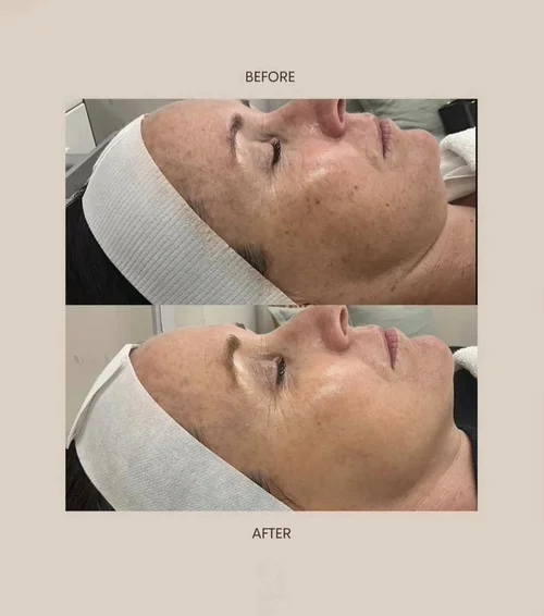 Acne and skin treatment before and after at Dolce Vita Aesthetics, Miami