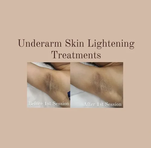 Underarm skin lightening before and after at Dolce Vita Aesthetics, Miami