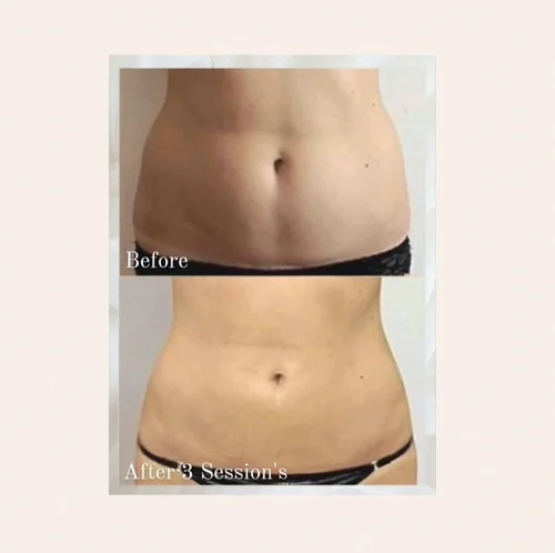 Non-surgical fat reduction before and after at Dolce Vita Aesthetics, Miami