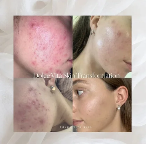 Acne and skin treatment before and after at Dolce Vita Aesthetics, Miami