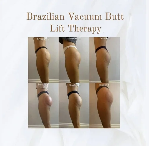 Brazilian vacuum butt lift before and after at Dolce Vita Aesthetics, Miami