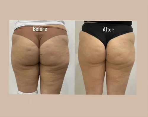 Body sculpting before and after at Dolce Vita Aesthetics, Miami