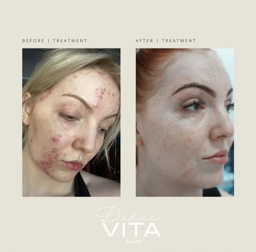 Acne and skin treatment before and after at Dolce Vita Aesthetics, Miami
