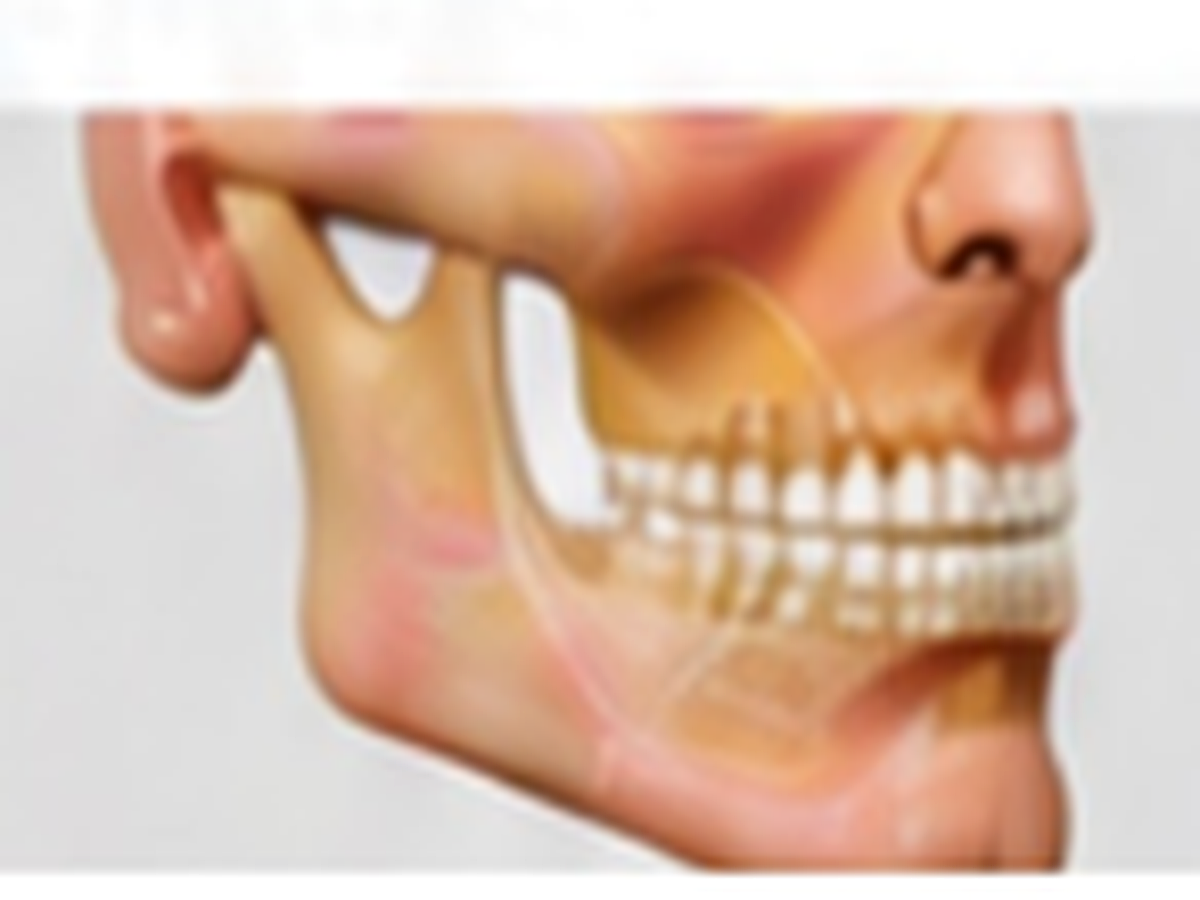 Maxillofacial surgical planning