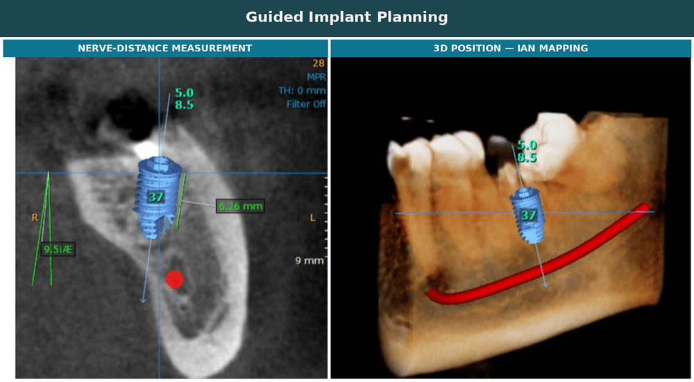 Dental implant planning