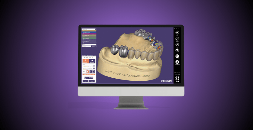 Interface du logiciel Exocad DentalCAD de conception dentaire