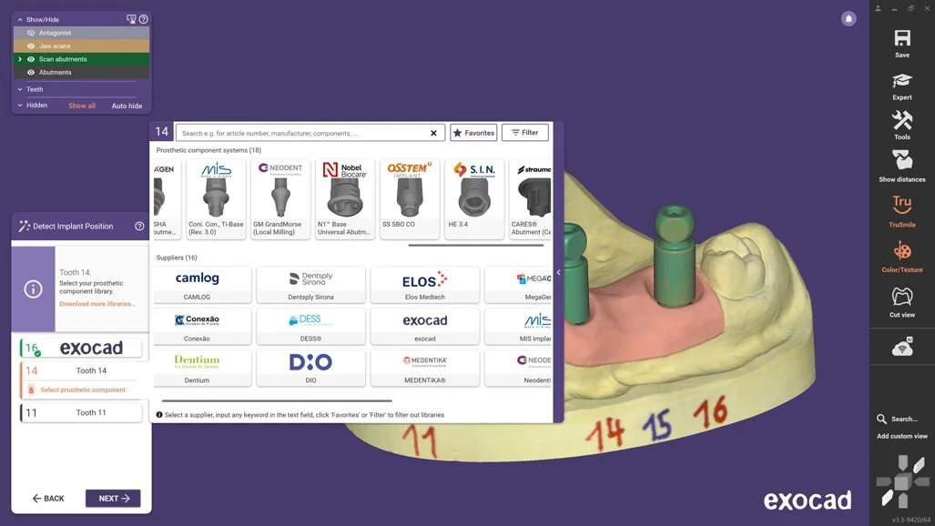 Conception d’une prothèse sur implant dans le logiciel Exocad DentalCAD